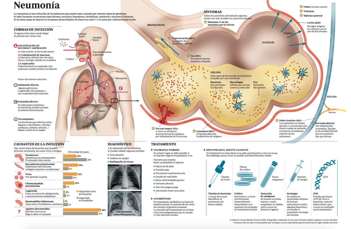 infografia pneumonia CUN