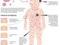 Infografía Varicela