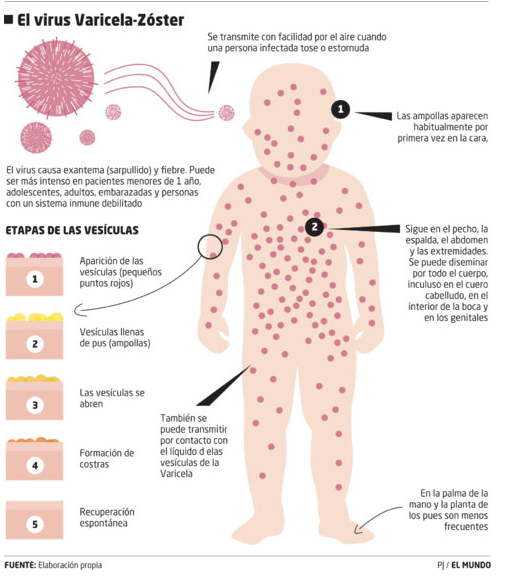 Infografía Varicela